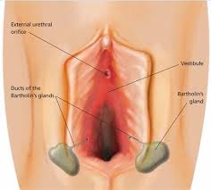 Image result for Bartholin's gland abscess