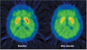 Image result for Placebo Effect