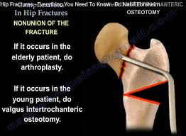 Image result for Fracture Complication