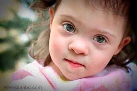 I was born with one, as was both the folds show in scandinavian children because the nasal bridge hasn't fully developed yet. A Closer Look At The Physical Characteristics Of Down Syndrome Ellen Stumbo