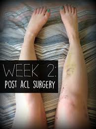 Post Acl Surgery Week 2 Acl Surgery Acl Surgery Recovery Knee Surgery Recovery