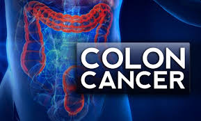 According to the centers for disease excluding very rare types, colon cancer develops in the cells lining the inside of the colon and/or rectum. New Recommendation For Colon Cancer Screenings At Age 45 Wavy Com