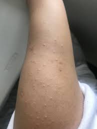 Your upper arms are covered with tiny bumps — what gives? Skin Concern There Are White Bumps On My Both My Arms And My Shoulders They Are Bigger Than What Keratosis Pilaris Would Look Like And They Re Not Red I Really Really Want