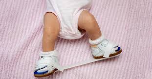 Image result for Clubfoot