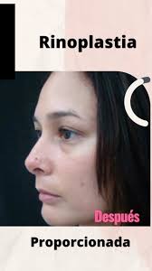 La rinoplastia estructural no solo cambia la forma de la nariz: Fortalece  su soporte interno para lograr resultados estables, armónicos y duraderos.  El Dr. Nelson Negrón emplea esta técnica avanzada para corregir