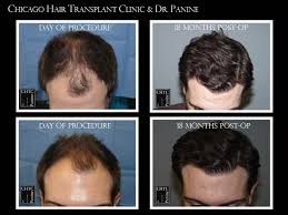 If your hair loss is caused by an underlying disease, treatment for that disease will be necessary. Before And After Photos Fue Chicago Chicago Hair Transplant Clinic