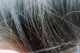 Kumpulan video kutu rambut terbanyak di kepala manusia, kutu rambutnya sampai berjatuhan di dijamin 100 % kutu rambut hilang !! Kutu Rambut Kanak Kanak Adakah Satu Masalah Besar Hello Doktor