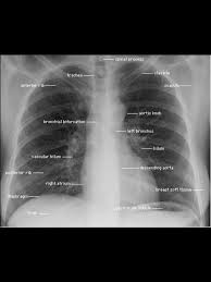 Chest Xray Annotation Medical Knowledge Radiology Student Medical Education