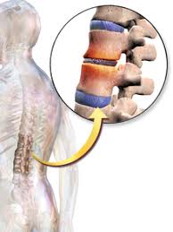 Back pain is a common symptom and affects most people at some point in their life. Back Pain Wikipedia