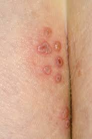 Bumps on buttocks can be painful and make it hard to sit. Herpes On The Buttocks Stock Image C026 3430 Science Photo Library