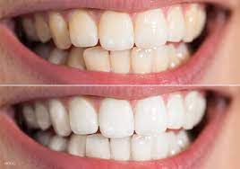 Dental veneers are a possible solution to help you achieve the look you desire. Can Porcelain Veneers Be Stained Antigone Skoulas Dds