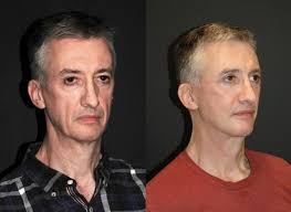 Truly surreal $200k+ face lifts by Dr. Jacono : r/redscarepod