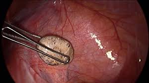 Absent ovary and peritoneal stone found at laparoscopy