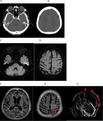 A statement for healthcare professionals from the american heart association/american stroke association. Clinical Trial Based Rationale For The Successful Use Of Doac In The Treatment Of Cerebral Venous Sinus Thrombosis Cvst A Case Report Journal Of Stroke And Cerebrovascular Diseases