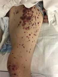 Image result for Vasculitis