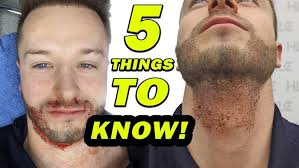 Beard Transplant Before and After