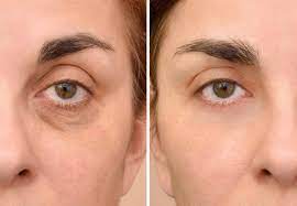Como Quitar Las Ojeras Oscuras Todos Los Trucos Aqui