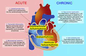 Myocarditis is a rare cause of cardiovascular disease primarily manifest as sudden death, chest pain or heart failure. Recognizing Covid 19 Related Myocarditis The Possible Pathophysiology And Proposed Guideline For Diagnosis And Management Heart Rhythm
