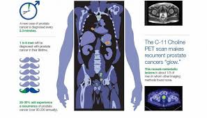 Some studies, according to the mayo clinic, have linked dairy products, or diets high in calcium, with an increased risk of prostate cancer. Mayo Clinic C 11 Choline Pet Scan Can Provide An Early Warning System For Recurrent Prostate Cancer Http Mayocl In 1uxp7hs Facebook