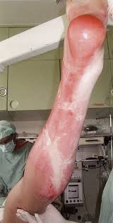 The rash that leads to eschar formation clin dermatol. Burns Amboss