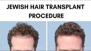 As people's complexions got lighter, the hair grew longer (for no reason except that the cel. Jewish Fue Hair Transplant Procedure Video Youtube