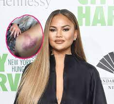 We did not find results for: Mega Bluterguss Chrissy Teigen Fiel Die Treppe Runter Promiflash De