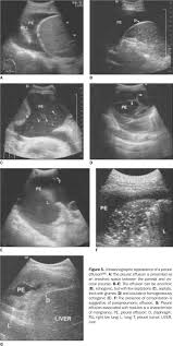 In healthy lungs, these membranes ensure that a small amount of liquid is present between the lungs. Scielo Brasil Papel Da Ultra Sonografia Na Avaliacao Da Efusao Pleural Papel Da Ultra Sonografia Na Avaliacao Da Efusao Pleural