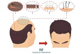 Check spelling or type a new query. Fut Hair Transplant In Turkey Aek Hair Clinic