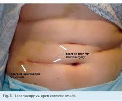 Laparoscopic Assisted Placement Of Ventriculo Peritoneal Shunt Tips In Children With Multiple Previous Open Abdominal Ventriculo Peritoneal Shunt Surgeries Semantic Scholar