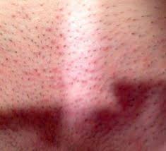 Shaving does tend to cause more problems than waxing however there have been clients that. Razor Rash Or Herpes
