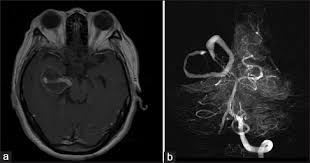 Cerebral aneurysm is a cerebrovascular disorder in which weakness in the wall of an intracranial artery causes. Giant Serpentine Aneurysm Of The Posterior Cerebral Artery A Rare Clinical Entity And Technical Challenge In Diagnosis And Treatment