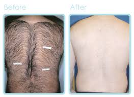 The cost of typical laser hair removal, according to doc shop depends upon the size of the area for hair removal. Laser Hair Removal L Spa Sarasota