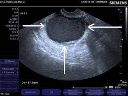 Endometriose ist eine der häufigsten erkrankungen bei frauen. Praxis Dr Helligrath Ultraschall Galerie