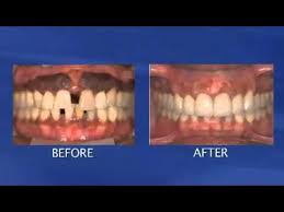 Dental Implant Dental Implants Gum Disease Treatment Periodontal Disease Youtube