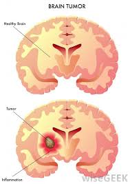 An mri is the study of choice for tumor, multiple sclerosis, and ischemic stroke. What Is A Brain Mri Without Contrast With Pictures