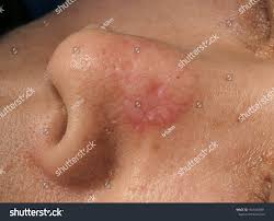 Image result for skin cancer on nose pimple