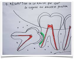 Elle se manifeste par de vives douleurs. Dents De Sagesse Avant Pendant Et Apres L Extraction