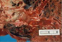 Signs and symptoms of small cell lung cancer include coughing and shortness of breath. Non Small Cell Lung Carcinoma Wikipedia