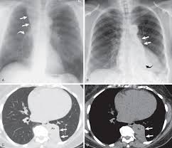 Image result for Atelectasis