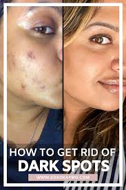 If you've been wondering how to get rid of hyperpigmentation, then you've come to the right place. How To Fade Dark Spots And Hyperpigmentation Dark Spots On Skin Hyperpigmentation Hyperpigmentation Spots