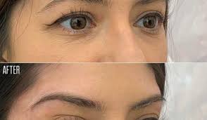 Since cataract surgery is considered a medically necessary procedure, the cost of cataract surgery is largely covered by private insurance or medicare, the latter of which covers most patients. Fox Eye With Botox