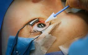 Image result for Cataract Extraction
