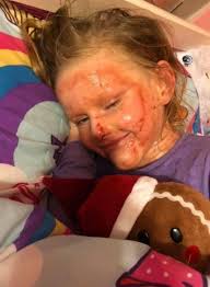 Tain girl's eczema plight inspires awareness drive