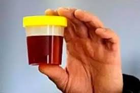Donkere Urine In De Ochtend Voor Vrouwen Mannen Kinderen Redenen Competent Over Gezondheid Op Ilive