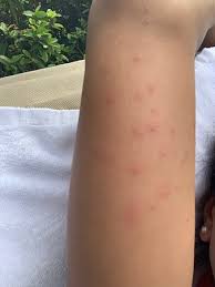 Check spelling or type a new query. Woke Up Itching Covered In This Rash Dust Mites Or Bed Bugs Hope The Hotel Does A Full Inspection But Bedrooms Full Of Old Fashioned Heavy Carpets Curtains And Crevices There Would