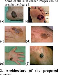 We treat common skin disorders and do yearly skin cancer checks. Skin Cancer Detection And Classification In Humans Semantic Scholar