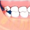 Report any excess bleeding, severe pain or any other unusual symptoms to your dentist or oral surgeon immediately. 1