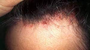 Skin cancer is the most common type of cancer and can develop anywhere on your skin. Psoriasis Vs Skin Cancer Pictures Knowing The Signs And More