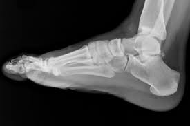 Image result for Ankle XRay