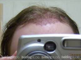 My hair is otherwise quite thick with exception of transplant perhaps its not so clear from photos but ive seen a nice improvement in the last 2 months. No Growth 7 Months After From My Hair Transplant With Photos Wrassman M D Baldingblog